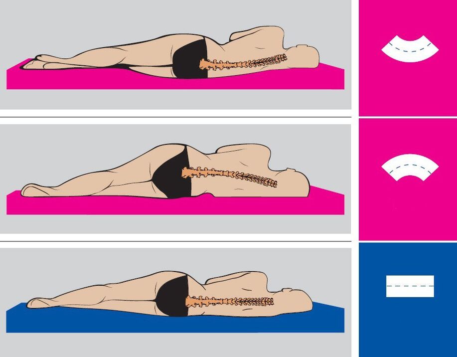 Σωστή θέση σώματος κατά τη διάρκεια του ύπνου με οσφυϊκή οστεοχόνδρωση